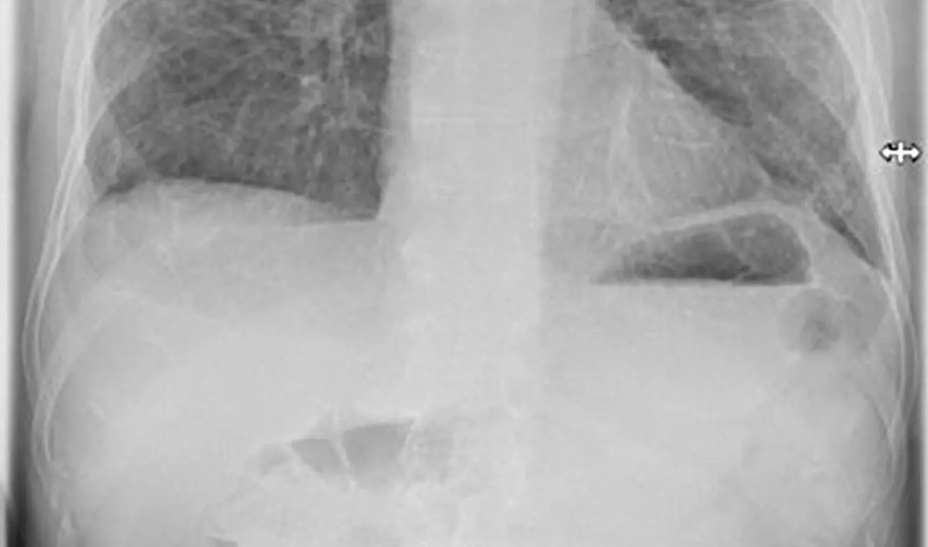 Das Röntgenbild zeigt die Lunge eines schwer an Covid-19 erkrankten 51-jährigen Mannes.