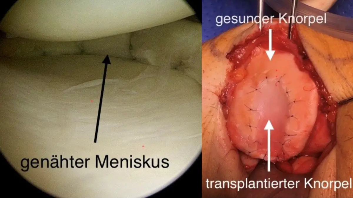 Minimalinvasive gelenkerhaltende Maßnahmen: Arthroskopische Naht eines gerissenen Meniskus im Kniegelenk (links). Knorpeltransplantation an der Rückseite der Kniescheibe (rechts).